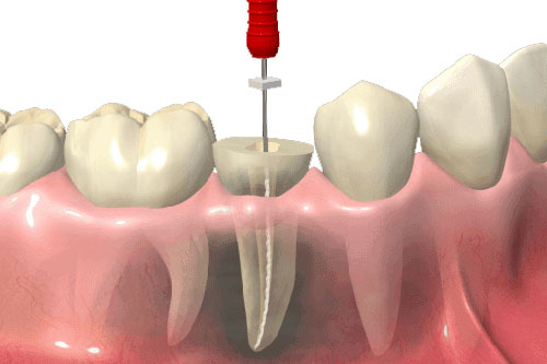 Endodoncia